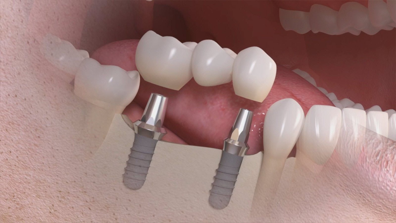 single-vs-multiple-dental-implants